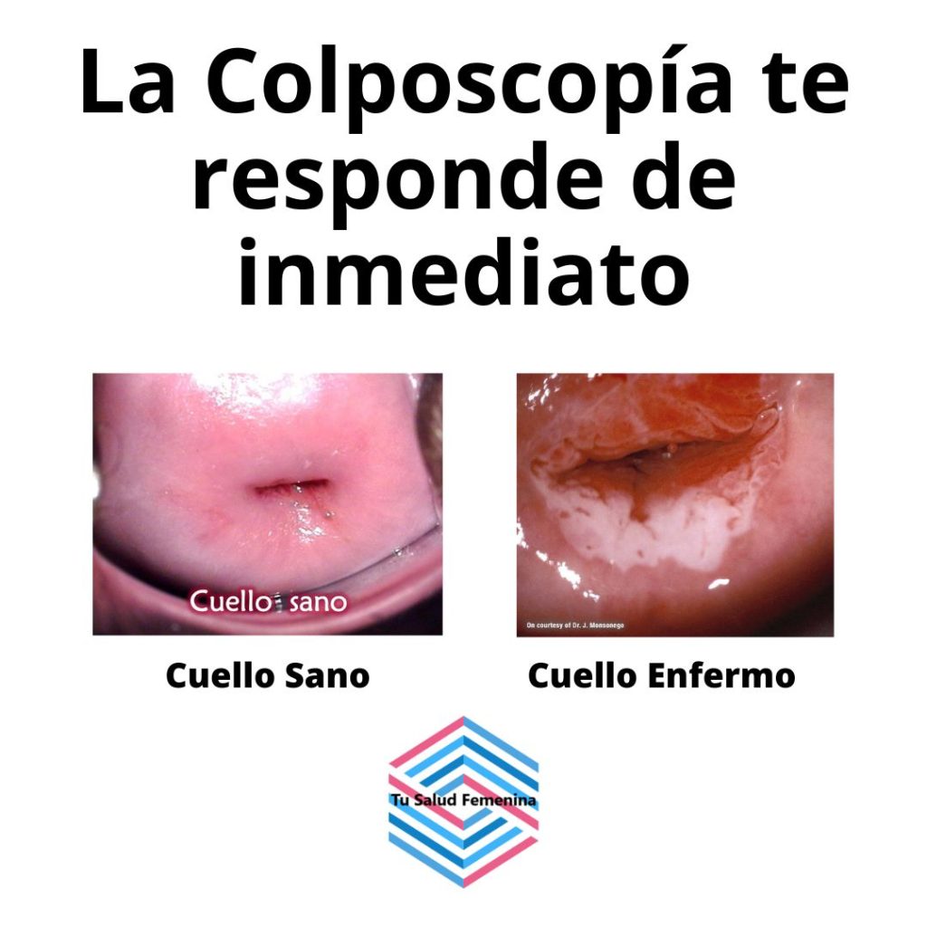 cervix comparativo